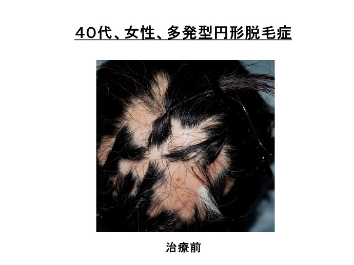 円形脱毛症　病院
